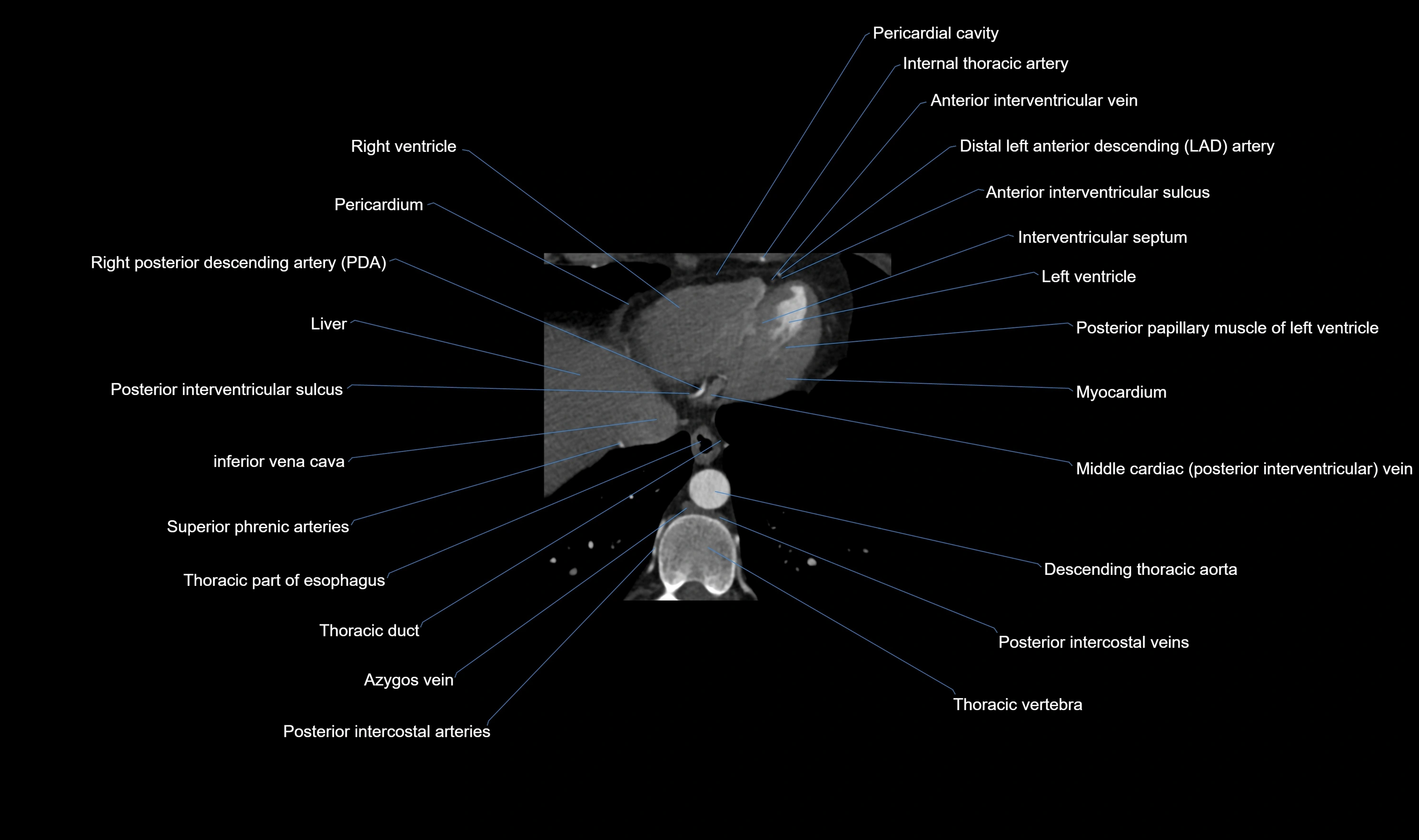 CT heart (coronary angiogram) axial view cross sectional anatomy labelled radiology image-00062.webp